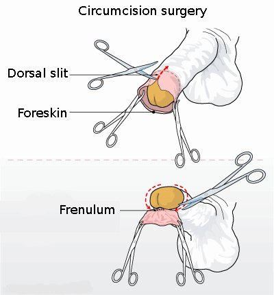 https://imgay.com/img/Circumcision_illustration.jpg